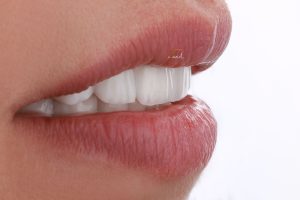 بهترین لمینیت دندان در مشهد